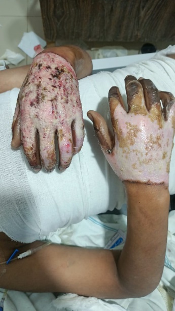 Preoperative clinical photograph of acute burn injuries affecting the hands