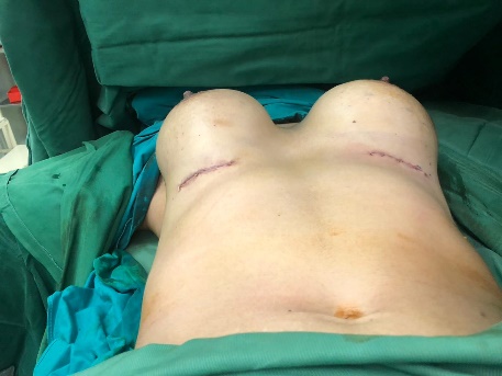 Immediate postoperative clinical photograph following breast implant surgery