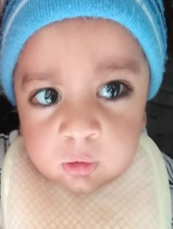 Postoperative clinical photograph following cleft lip and palate surgery