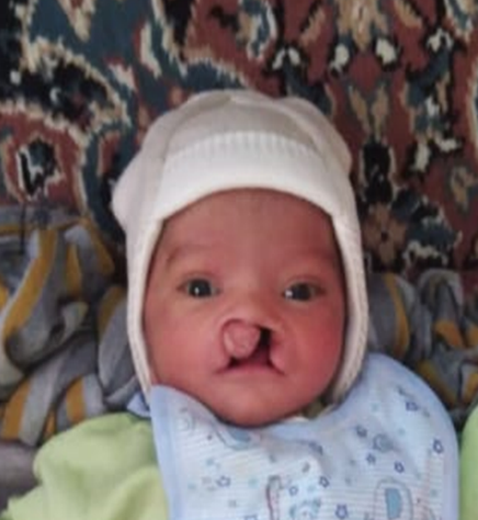 Preoperative clinical photograph before cleft lip and palate surgery