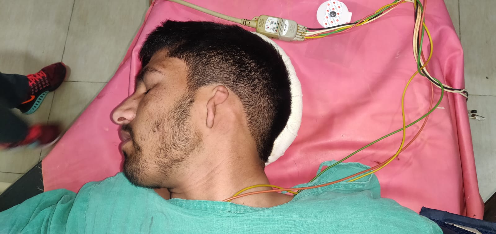 Preoperative side-view photograph before ear reconstruction