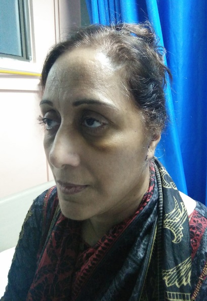 Postoperative photograph following face-lift surgery
