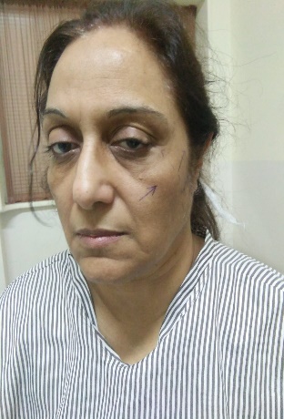 Preoperative photograph before face-lift surgery