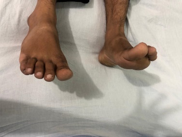 Clinical photograph showing foot drop and lower-limb positioning