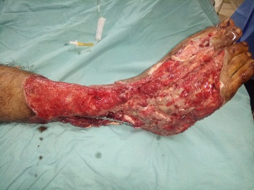 Clinical photograph during treatment of a lower-limb soft-tissue defect