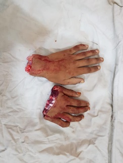 Preoperative clinical photograph before hand and upper-limb reconstruction