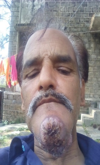 Preoperative clinical photograph before head and neck tumour reconstruction