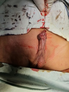 Preoperative clinical photograph before hypospadias reconstruction