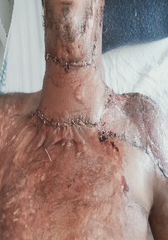 Postoperative photograph following reconstruction of neck and upper-chest burn scarring