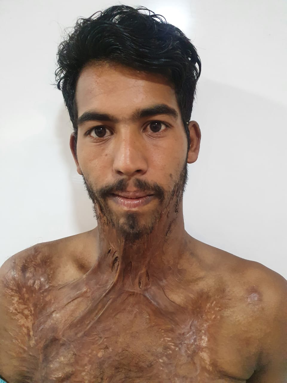 Preoperative photograph showing mature burn scarring of the neck and upper chest