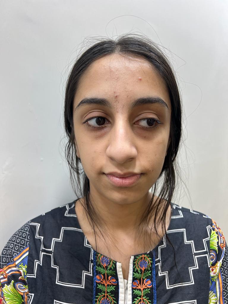Preoperative frontal photograph before rhinoplasty